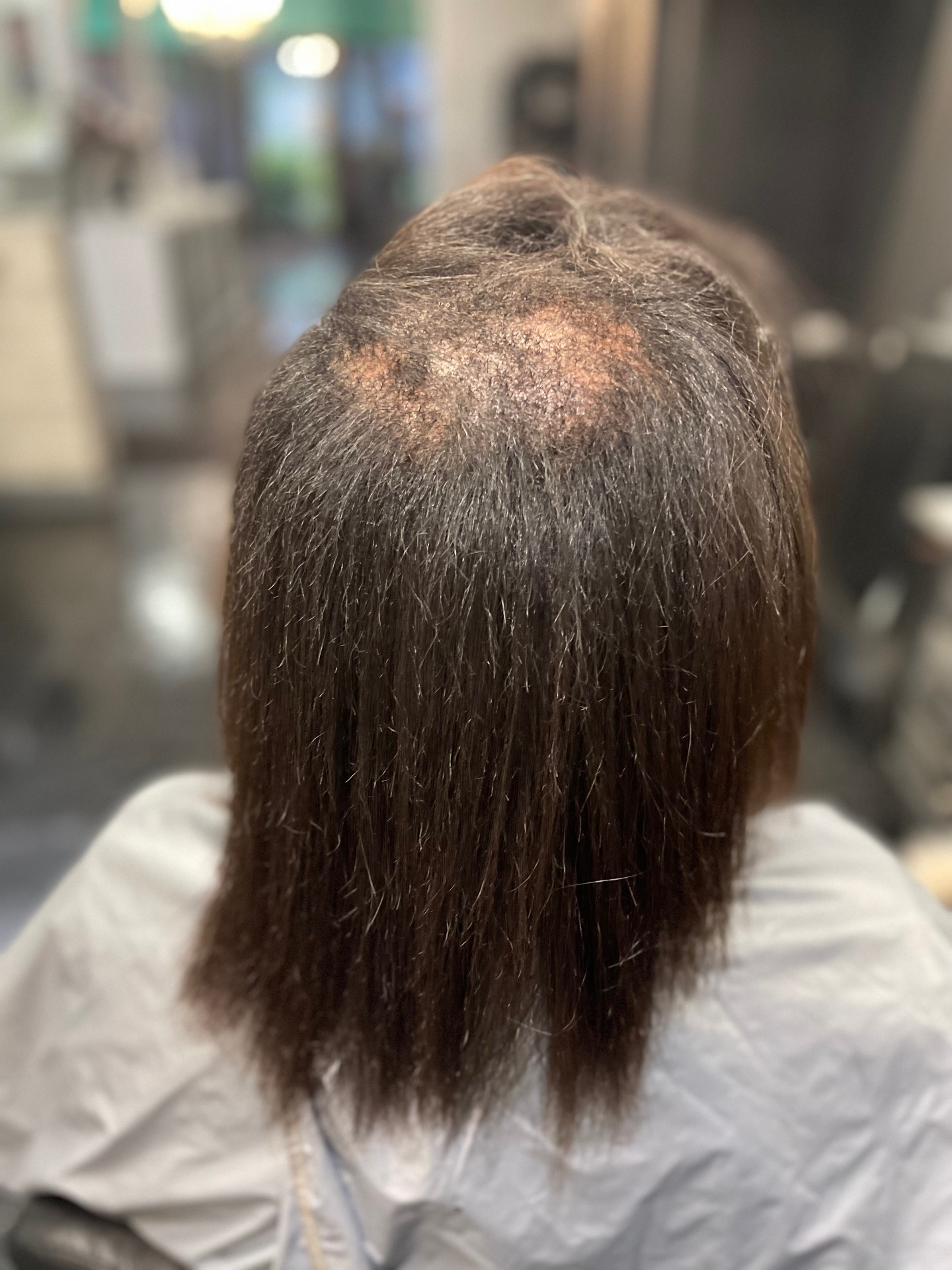 Hair Restoration Consultation